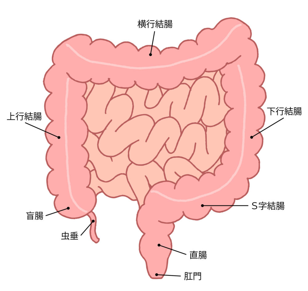 大腸がんとは