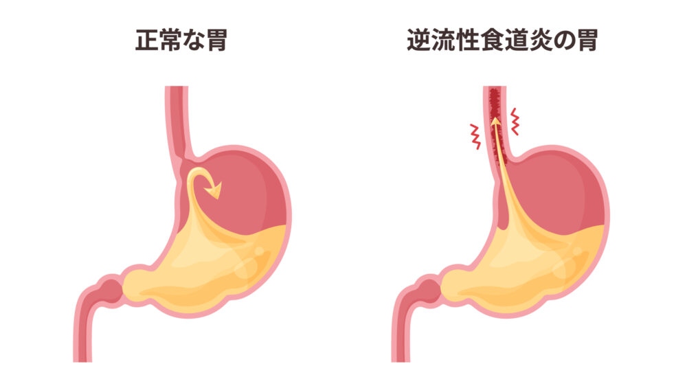 逆流性食道炎とは