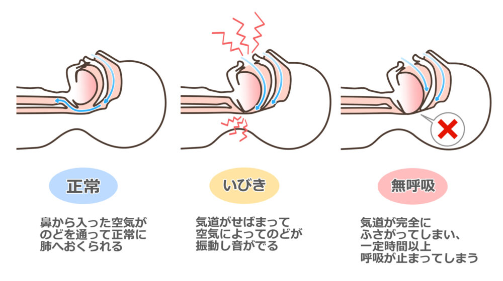 睡眠時無呼吸症候群の原因